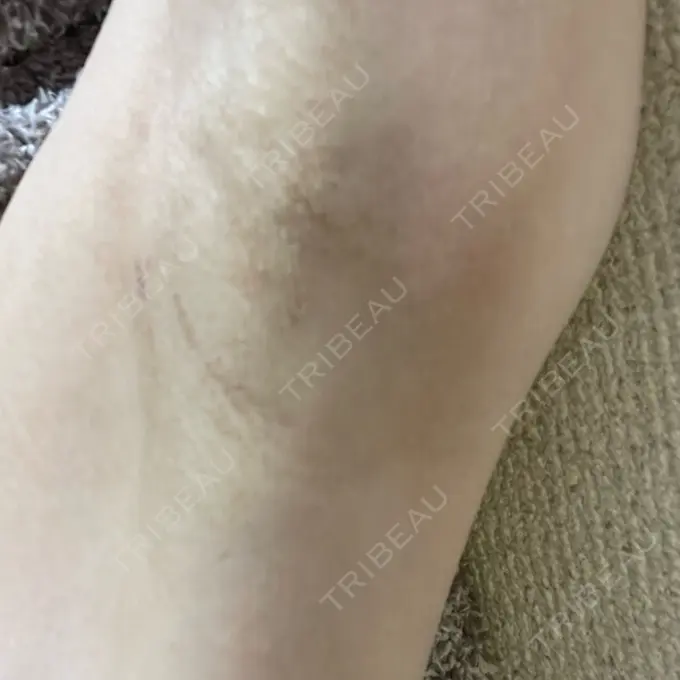 ワキ汗治療（切開） 東京シンデレラ美容外科 池袋院 BEFORE メイン用