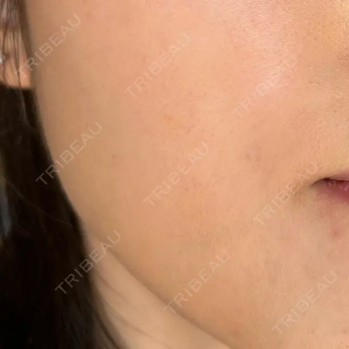 ボトックス（エラ・小顔） TCB東京中央美容外科 立川院 BEFORE メイン用