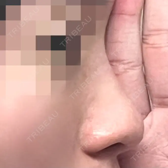 鼻尖形成（切開） / 小鼻縮小（切開） / 軟骨移植 / 鼻孔縁下降 / ヒアルロン酸注入（鼻） ziz CLINIC BEFORE メイン用