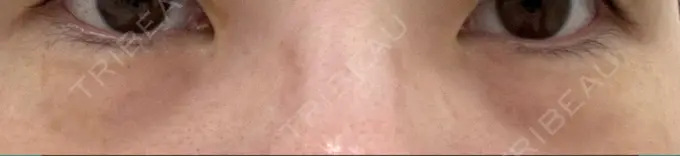 クマ治療 / 下まぶたの脂肪取り / 脂肪注入（目の下） / その他（目元） 東京シンデレラ美容外科 池袋院 BEFORE メイン用