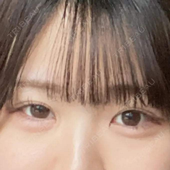 眼瞼下垂（非切開） SOL CLINIC BEFORE メイン用