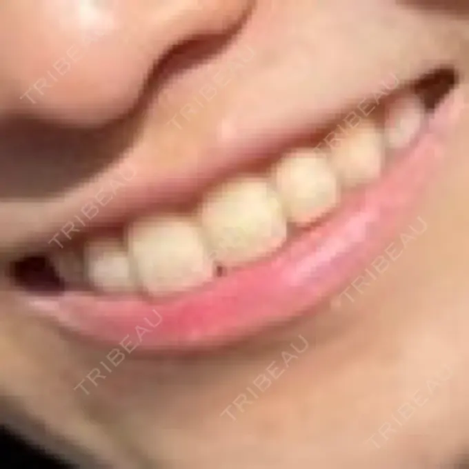 ホワイトニング オーラルビューティークリニック クラリス審美歯科・矯正歯科 BEFORE メイン用