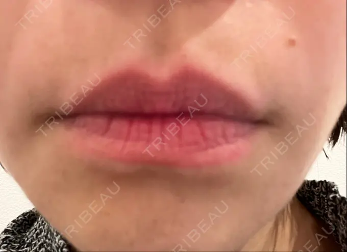 ボトックス（人中） veary clinic BEFORE メイン用