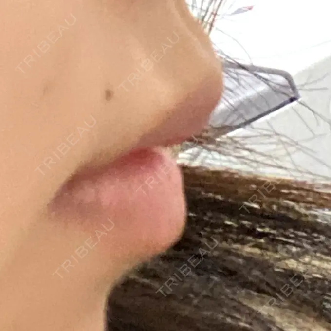 ヒアルロン酸注入（涙袋） / ヒアルロン酸注入（唇） ファイヤークリニック 名古屋院 BEFORE メイン用