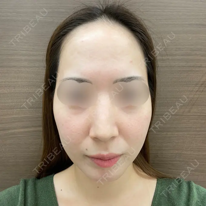 糸リフト / クマ治療 / 脂肪注入（額） / 鼻翼基部形成（貴族手術） / 脂肪注入（目の下） 大阪TAクリニック BEFORE メイン用