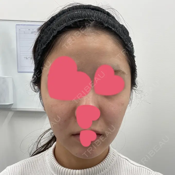 脂肪吸引（顔） / メーラーファット除去 / 脂肪吸引注射（顔） / その他（輪郭） 東京シンデレラ美容外科 池袋院 BEFORE メイン用