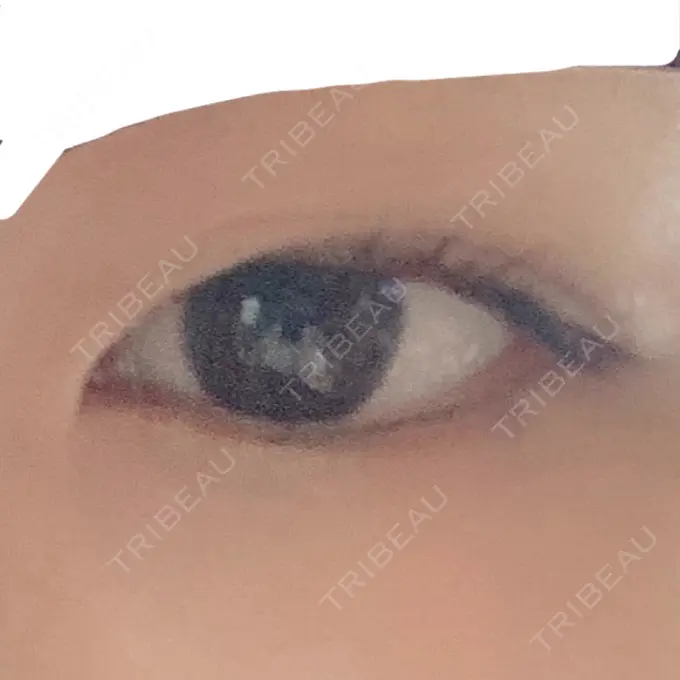 二重切開 よこはまエーブクリニック BEFORE メイン用