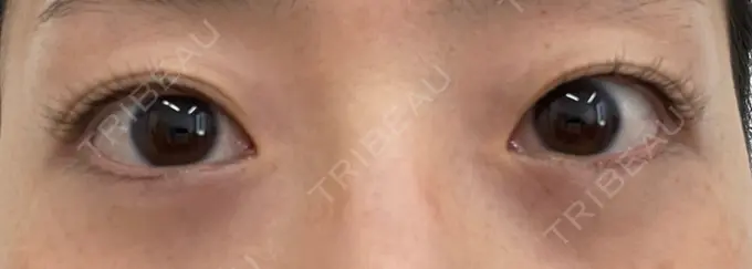 二重埋没 湘南美容クリニック 京都院 BEFORE メイン用