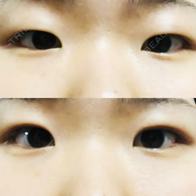 二重埋没 / 上まぶたの脂肪取り 東京ヒルズクリニック 岡崎院 BEFORE メイン用