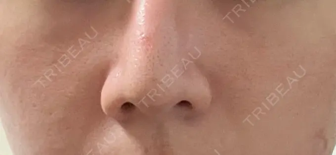 鼻孔縁挙上 くさのたろうクリニック BEFORE メイン用