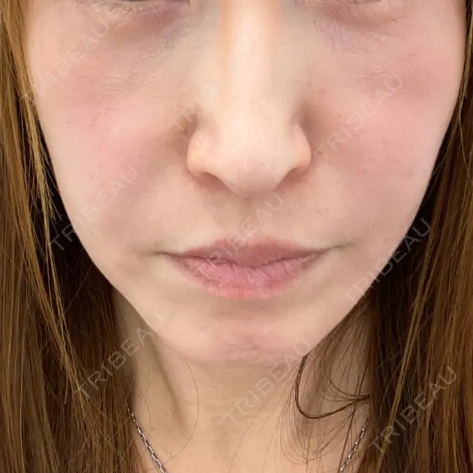 糸リフト / 肌ヒアルロン酸注入（たるみ・シワ改善） TCB東京中央美容外科 宇都宮院 BEFORE メイン用