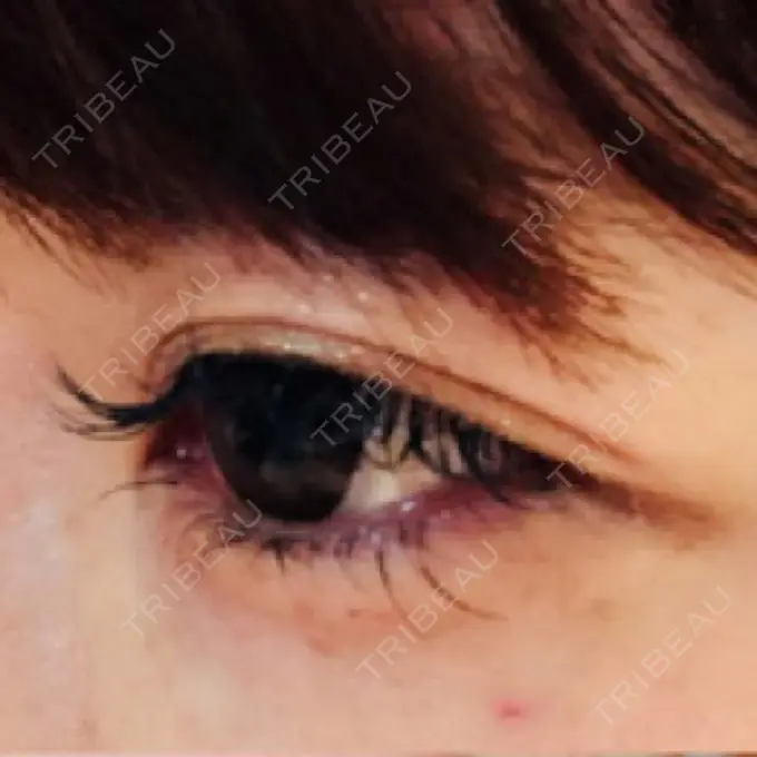 ヒアルロン酸注入（涙袋） 衣理クリニック表参道 BEFORE メイン用