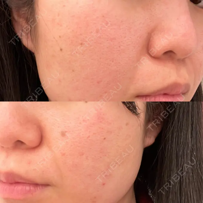 ピーリング（ニキビ・毛穴） / ポテンツァ A CLINIC（エークリニック） 仙台院 BEFORE メイン用