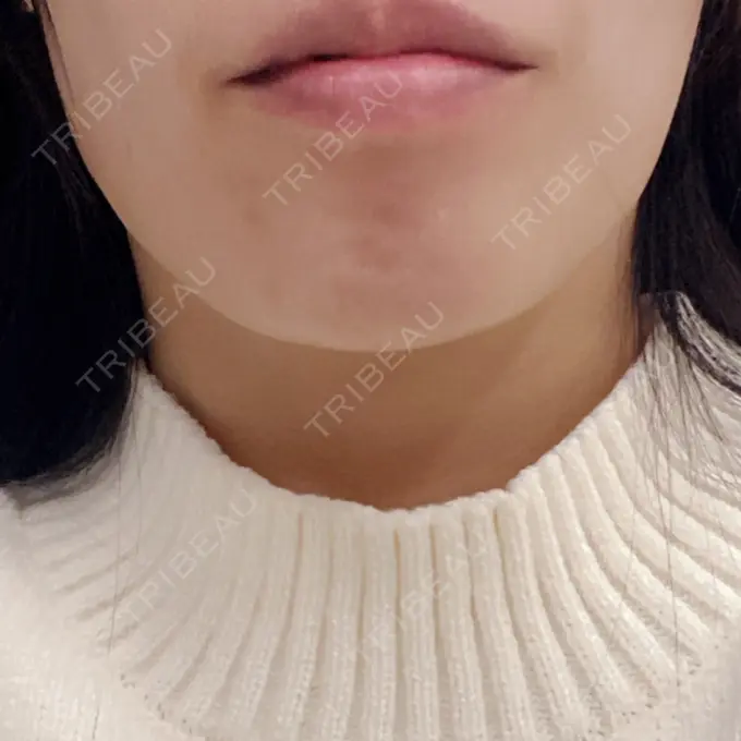 ボトックス（あご） / 肌ヒアルロン酸注入（たるみ・シワ改善） / ボトックス（目尻） TCB東京中央美容外科 心斎橋院 BEFORE メイン用