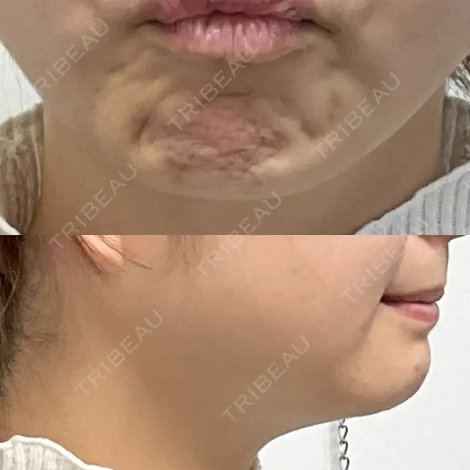 ボトックス（あご） / ボトックス（エラ・小顔） / ボトックス（眉間） M'sクリニック【エムズクリニック】 BEFORE メイン用