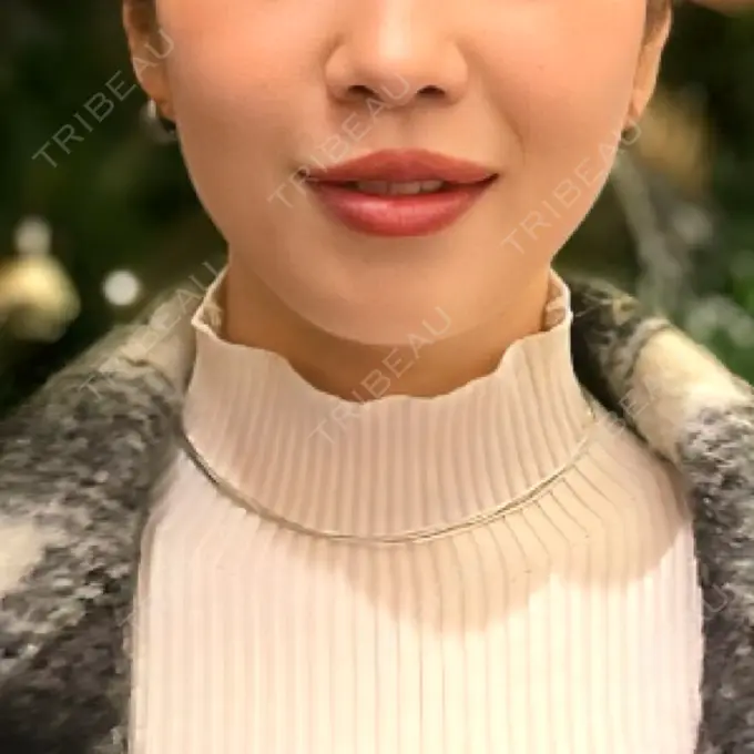 ボトックス（エラ・小顔） / ヒアルロン酸注入（唇） / ボトックス（口角） フィラークリニック 大阪梅田院 BEFORE メイン用