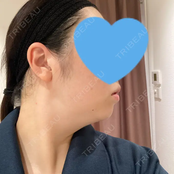 脂肪吸引（顔） Mods Clinic（モッズクリニック） 福岡院 BEFORE メイン用