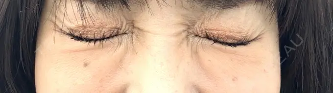 ボトックス（目尻） TCB東京中央美容外科 岡山院 BEFORE メイン用