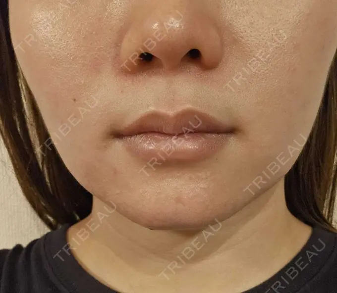 その他（口元） 東京銀座A CLINIC デンタル BEFORE メイン用