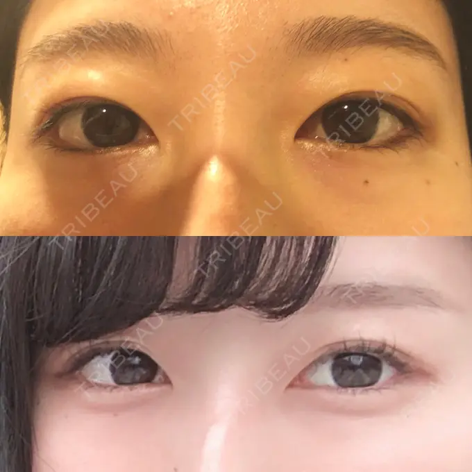 二重埋没 MIYAフェイスクリニック BEFORE メイン用