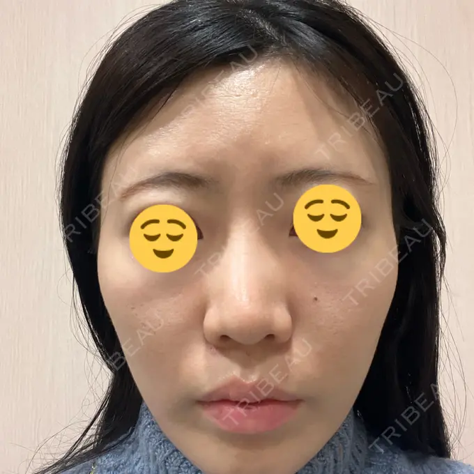 ハイフ（顔） TCB東京中央美容外科 静岡院 BEFORE メイン用