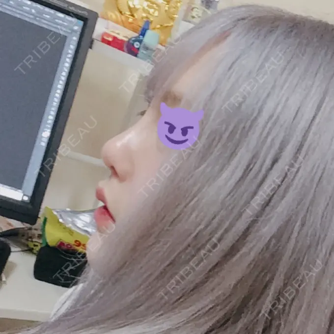 鼻尖形成（切開） / 鼻中隔延長（切開） / 眉間プロテーゼ / 鼻修正 FROM B整形外科 (旧バウム整形外科) BEFORE メイン用