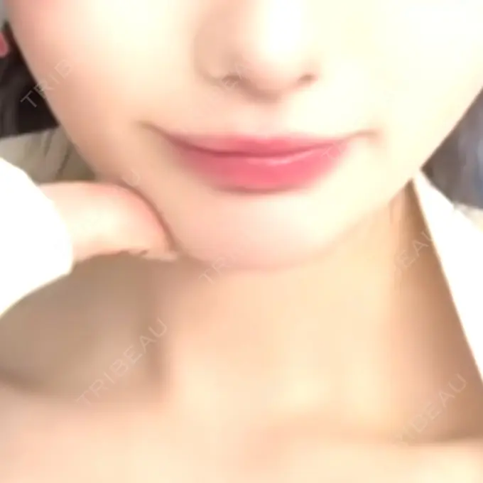 ヒアルロン酸注入（唇） / ボトックス（口角） フィラークリニック 渋谷院 BEFORE メイン用