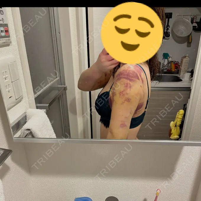 インディバ（二の腕） WOM SALON【術後ケア取扱いサロン】 BEFORE メイン用