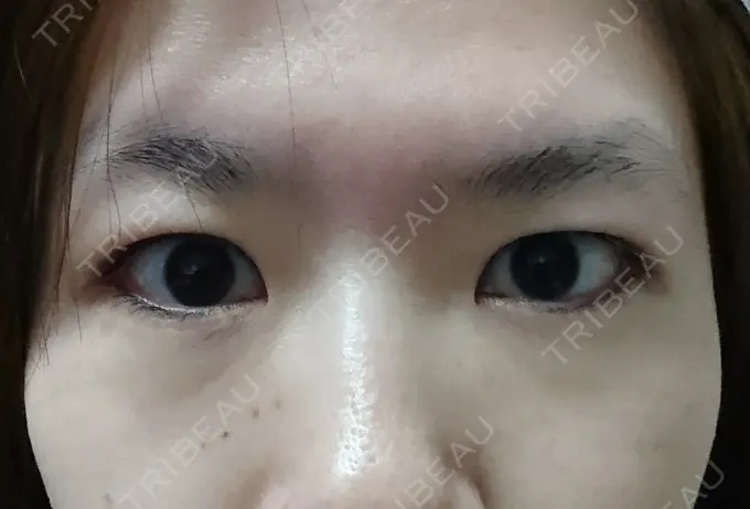 二重埋没 湘南美容クリニック 鹿児島院 BEFORE メイン用