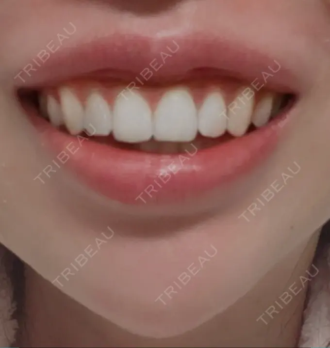 ボトックス（ガミースマイル） 椿クリニック 心斎橋院 BEFORE メイン用