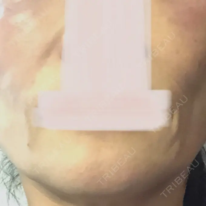 プラセンタ注射 美容皮膚科エルムクリニック 麻布院 BEFORE メイン用