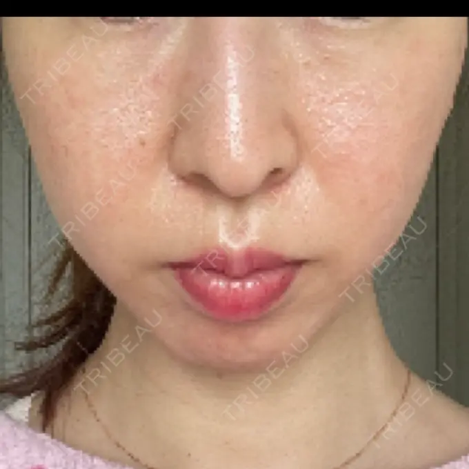 光治療（フォトフェイシャルなど） ゆめビューティークリニック BEFORE メイン用