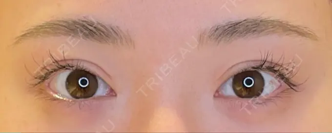 目尻切開 / タレ目形成・グラマラスライン（埋没） LOUIS CLINIC 二子玉川院【ルイクリニック】 BEFORE メイン用