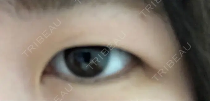 二重埋没 湘南美容クリニック 仙台院 BEFORE メイン用