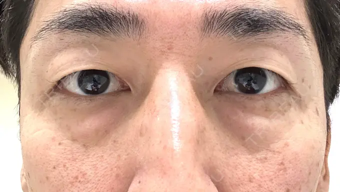 下まぶたたるみ取り / 脂肪注入（目の下） 湘南美容クリニック 池袋東口院 BEFORE メイン用