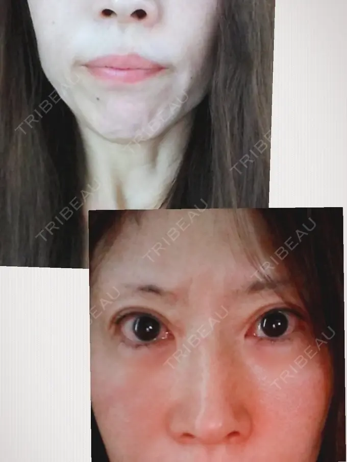 糸リフト / タレ目形成・グラマラスライン（切開） / ボトックス（あご） 品川スキンクリニック広島院 BEFORE メイン用