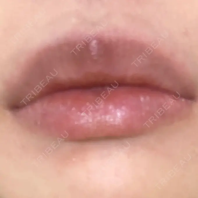 ボトックス（口角） しらゆりメディカルクリニック （旧しらゆりビューティークリニック） BEFORE メイン用