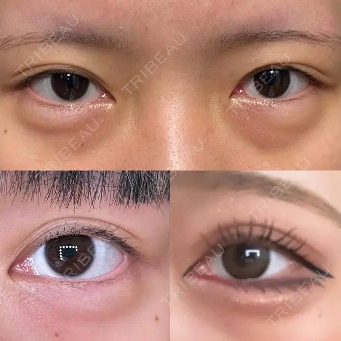 二重切開 / 目頭切開 / クマ治療 / 目尻切開 / 上まぶたたるみ取り / 下まぶたの脂肪取り / 脂肪注入（目の下） 湘南美容クリニック 大阪堺東院 BEFORE メイン用