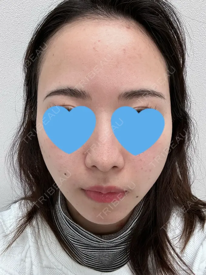 毛穴洗浄（ハイドラフェイシャルなど） / ヴェルヴェットスキン 日本美容・医療クリニック 六本木院 BEFORE メイン用