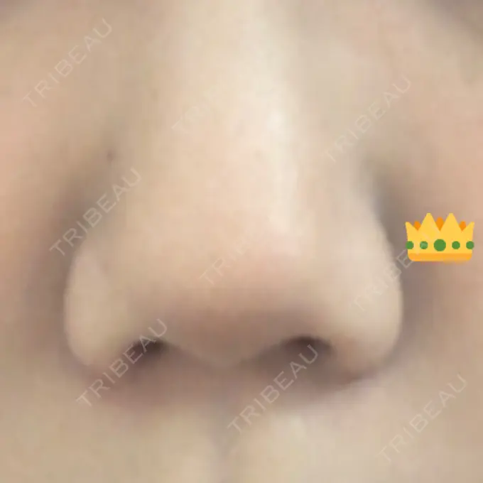 隆鼻術 / 鼻尖形成（切開） / 小鼻縮小（切開） / 軟骨移植 / 鼻翼挙上 / 鼻柱下降・鼻唇角形成（猫手術） Designo Clinic （デジーノクリニック） BEFORE メイン用