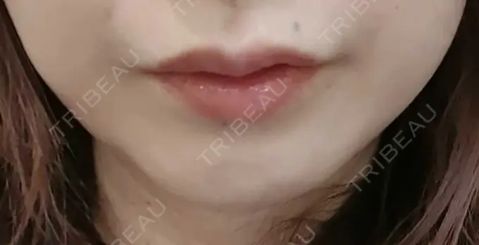 ヒアルロン酸注入（唇） / ボトックス（人中） id美容クリニック 銀座院 BEFORE メイン用