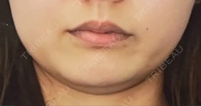 脂肪吸引（顔） 大塚美容形成外科 金沢院 BEFORE メイン用