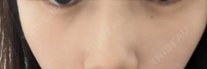 ヒアルロン酸注入（頬） / ヒアルロン酸注入（目の下） ルラ美容クリニック 神戸院 BEFORE メイン用