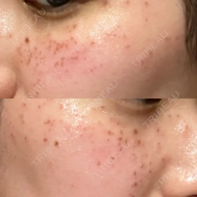 シミ取りレーザー Mavie Beauty Clinic （マヴィービューティークリニック） BEFORE メイン用