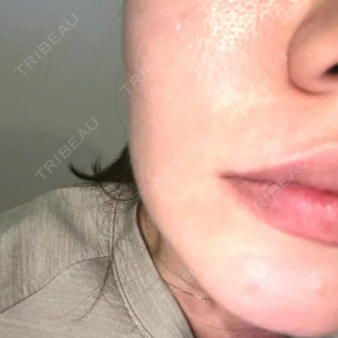 肌ヒアルロン酸注入（たるみ・シワ改善） 横浜TAクリニック BEFORE メイン用