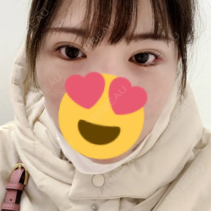 ヒアルロン酸注入（涙袋） / ボトックス（タレ目） フィラークリニック 渋谷院 BEFORE メイン用