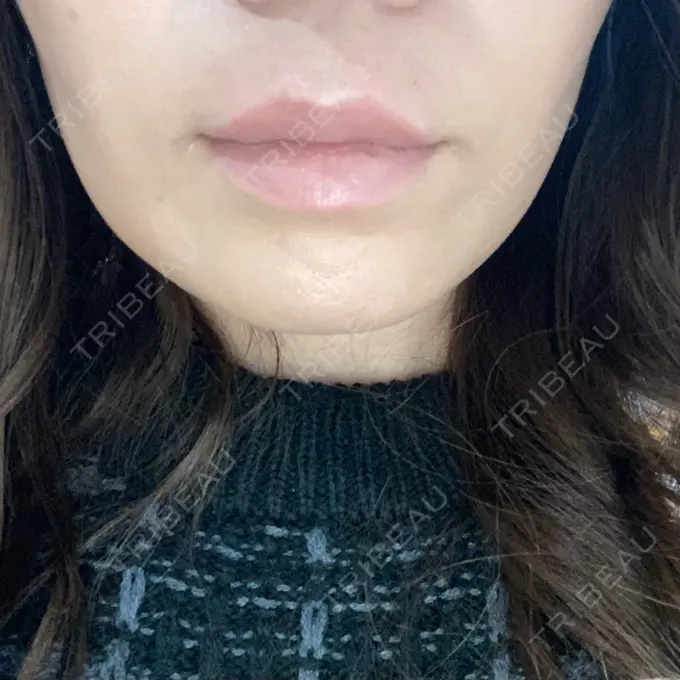 ボトックス（人中） veary clinic BEFORE メイン用