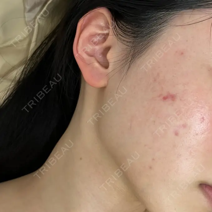 ニードルRF（ポテンツァなど） 東京美容外科 池袋院 BEFORE メイン用