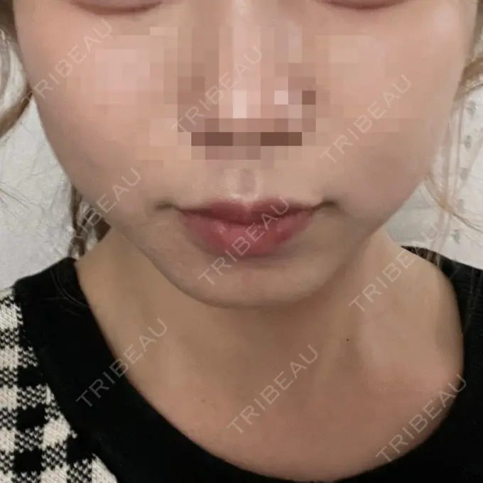 ヒアルロン酸注入（あご） / ボトックス（エラ・小顔） フィラークリニック 渋谷院 BEFORE メイン用