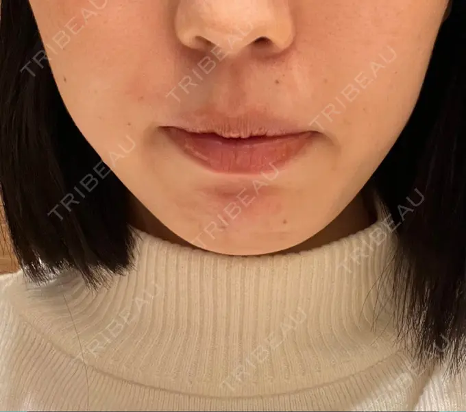 ボトックス（口角） 東京美容外科 福岡院 BEFORE メイン用